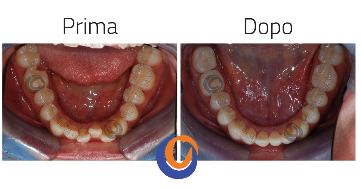 Trattamento ortodontico con allineatori trasparenti per affollamento dentale in paziente adulto - risultato prima e dopo - Studio Dentistico Caneva Trieste
