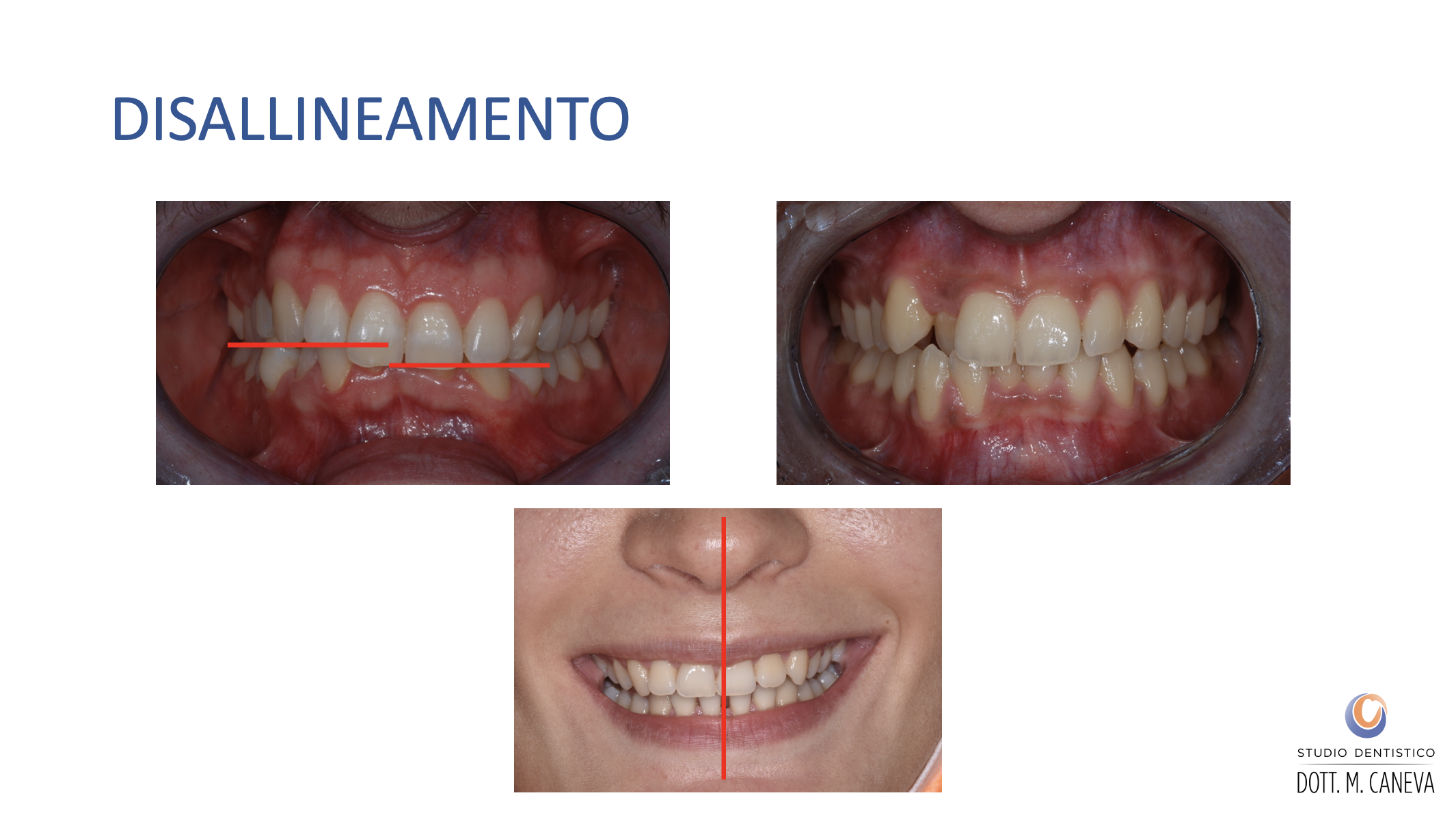 Caso clinico disallineamento della linea mediana in paziente adulta - asimmetria del sorriso - Studio Dentistico Caneva Trieste