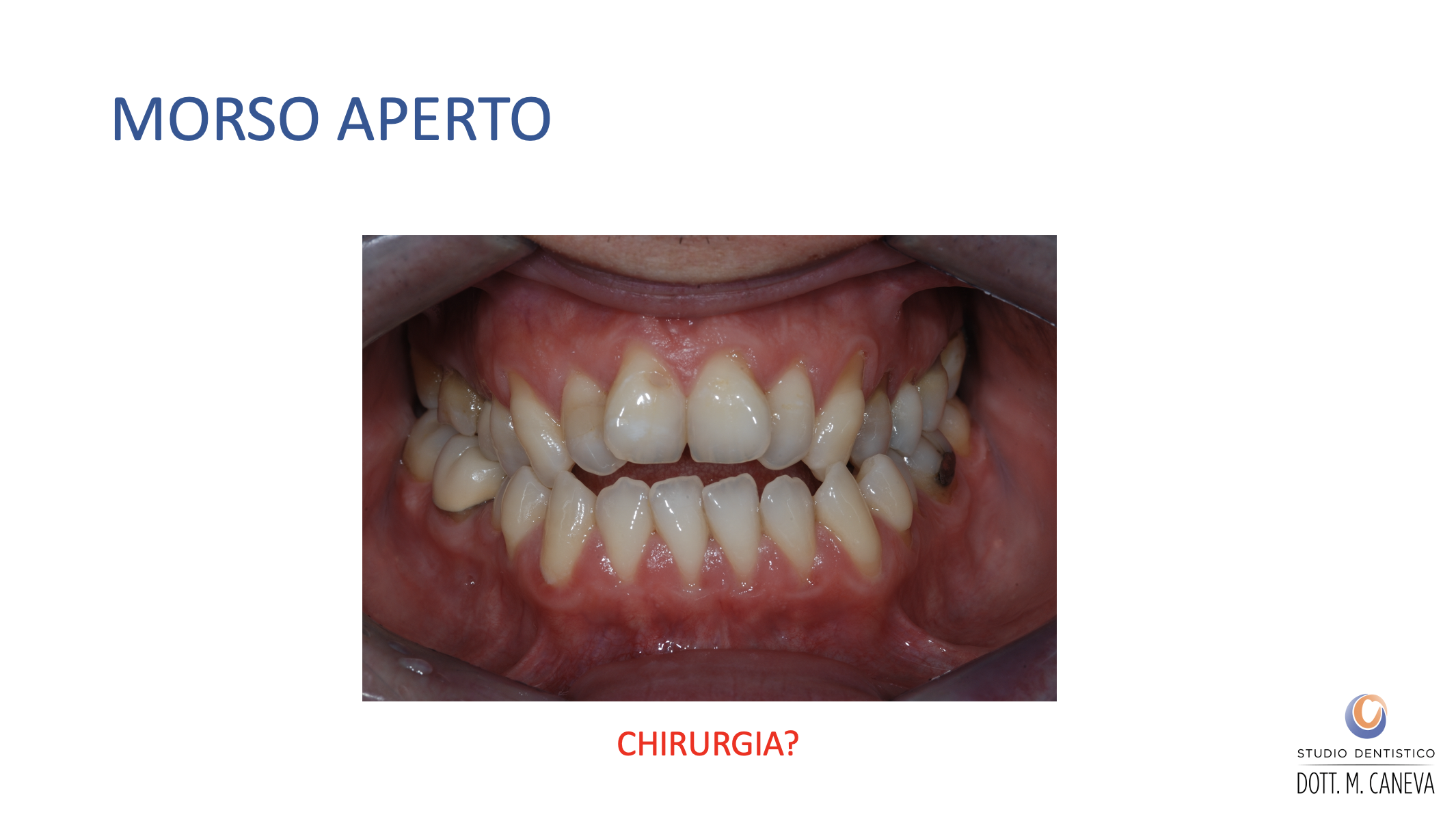 Caso clinico morso aperto in paziente adulto - spazio tra arcata superiore e inferiore - Studio Dentistico Caneva Trieste