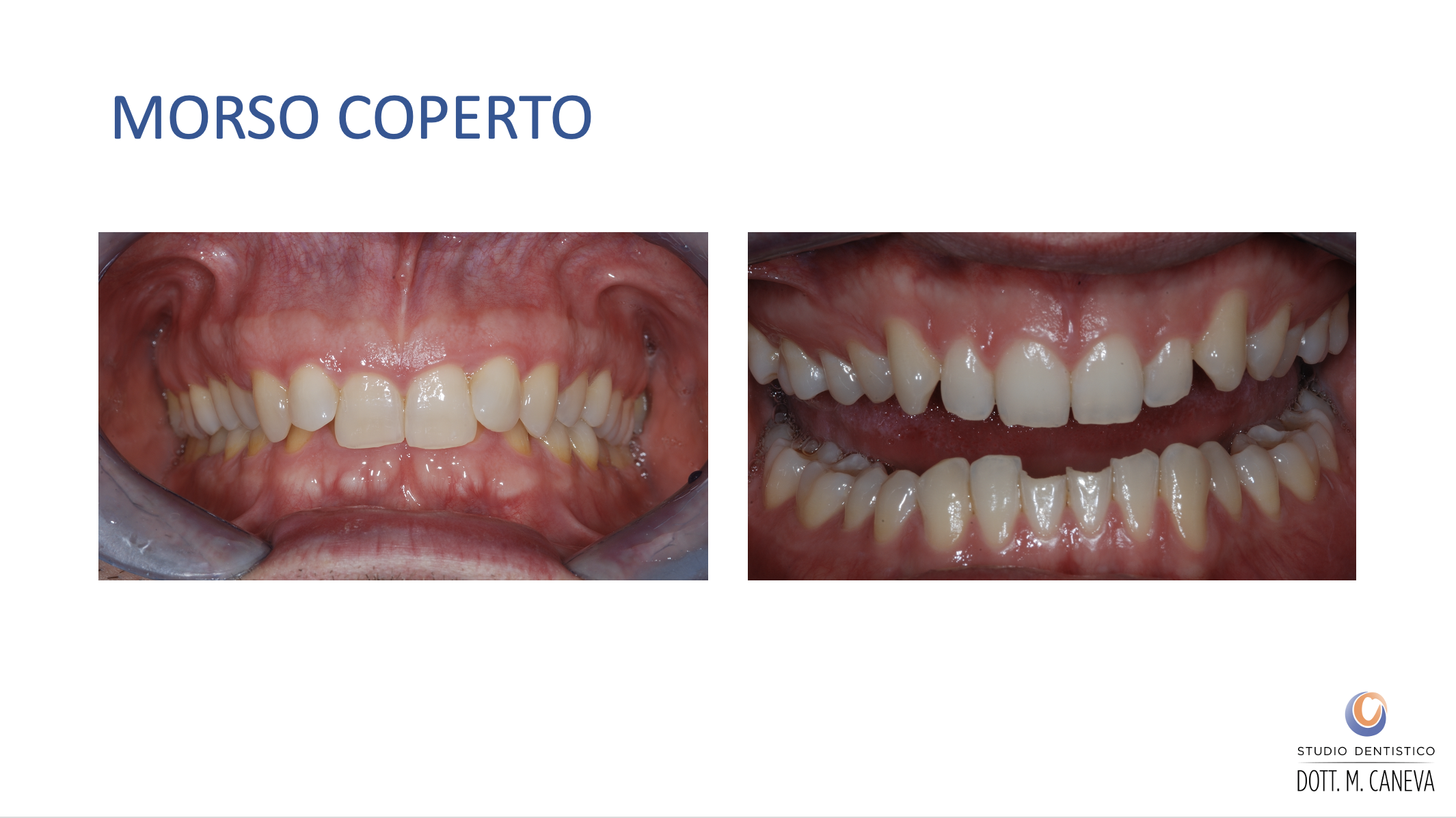 Caso clinico morso coperto in paziente adulto - denti superiori sovrappongono completamente gli inferiori - Studio Dentistico Caneva Trieste