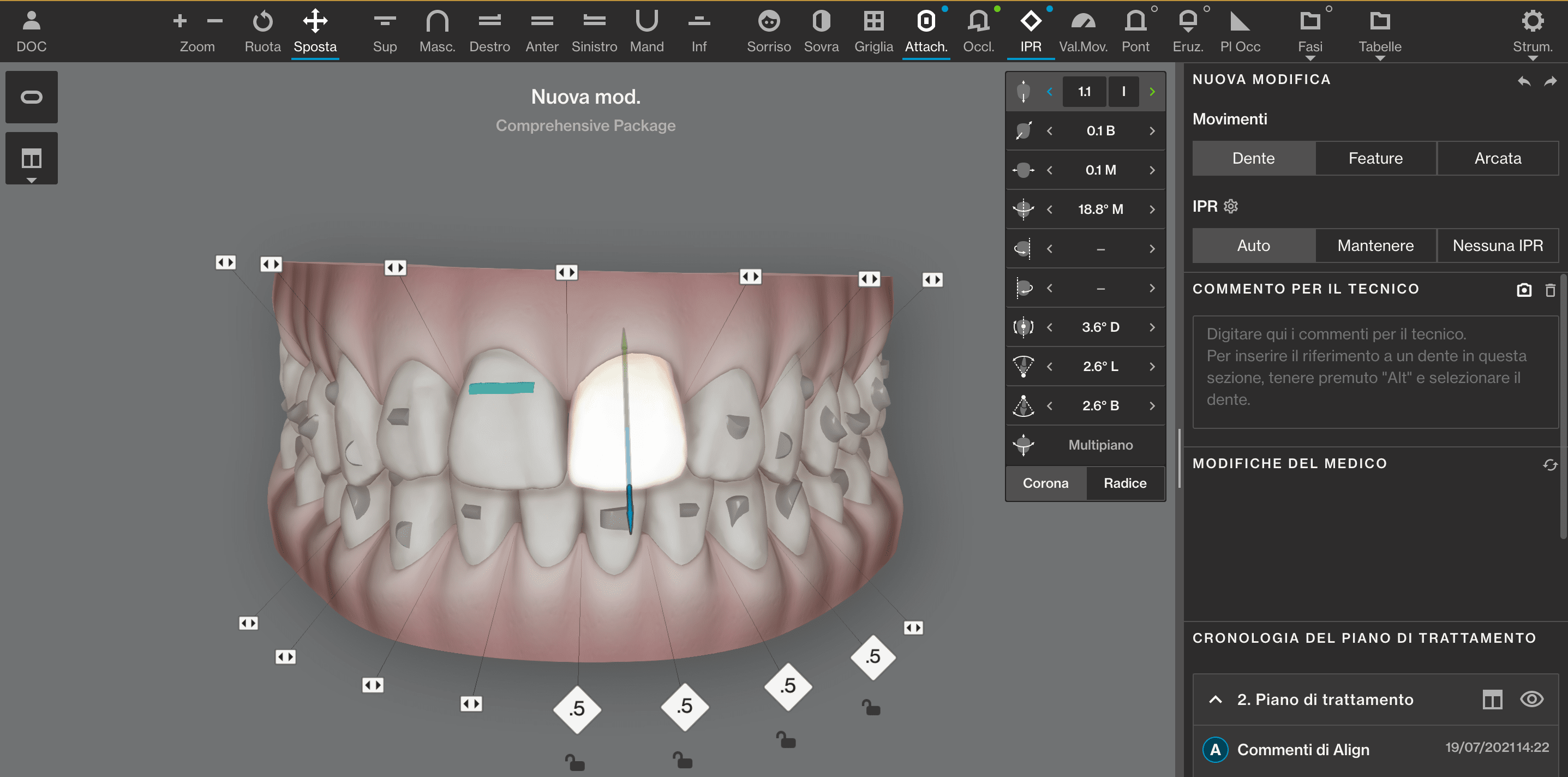 Pianificazione digitale 3D del trattamento con allineatori trasparenti – Studio Dentistico Caneva Trieste