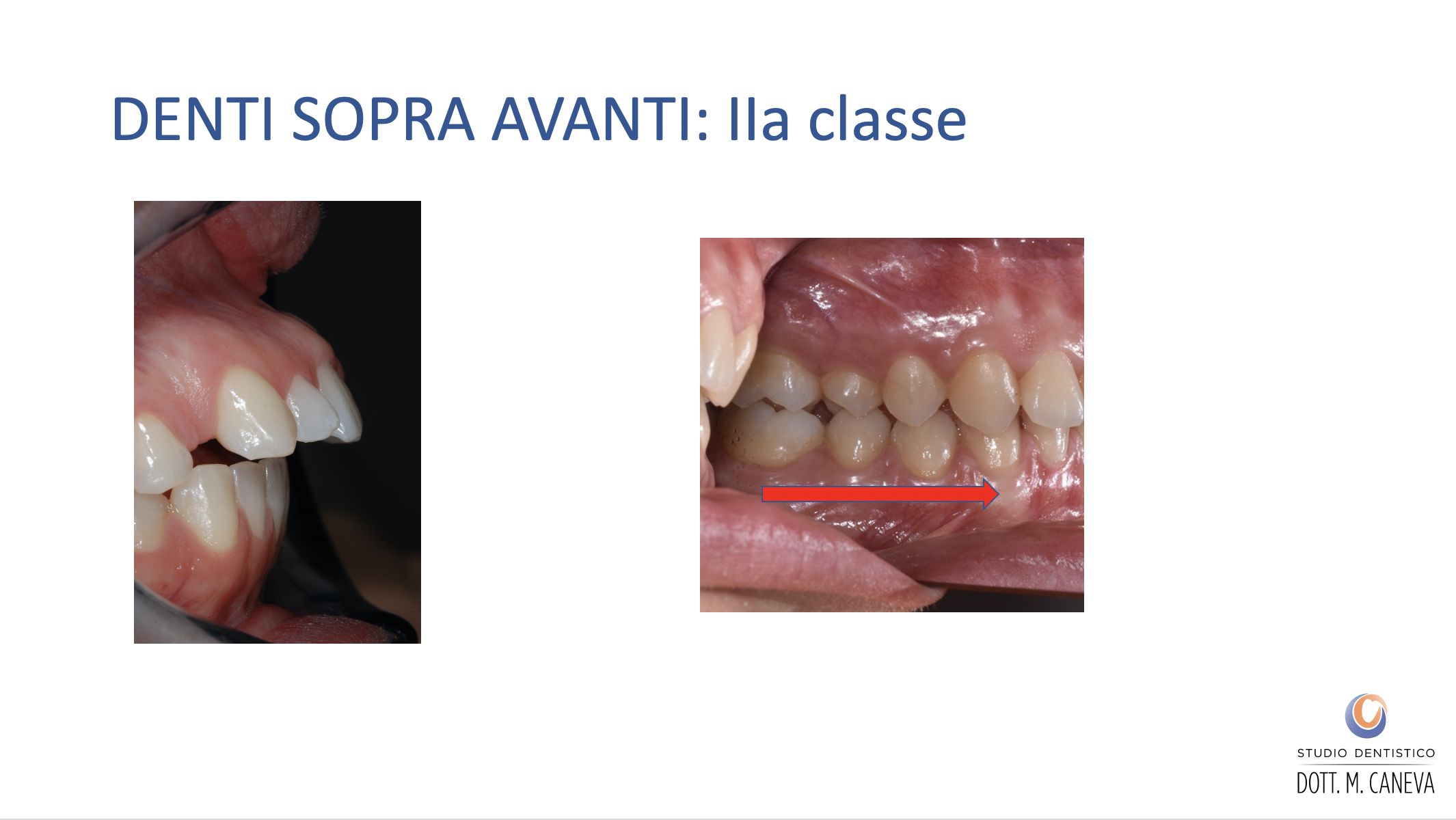 Caso clinico malocclusione di II classe in paziente adulto - denti superiori sporgenti - Studio Dentistico Caneva Trieste
