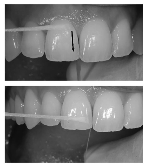 Studio Dentistico Caneva - Indicazioni sull'uso dello spazzolino